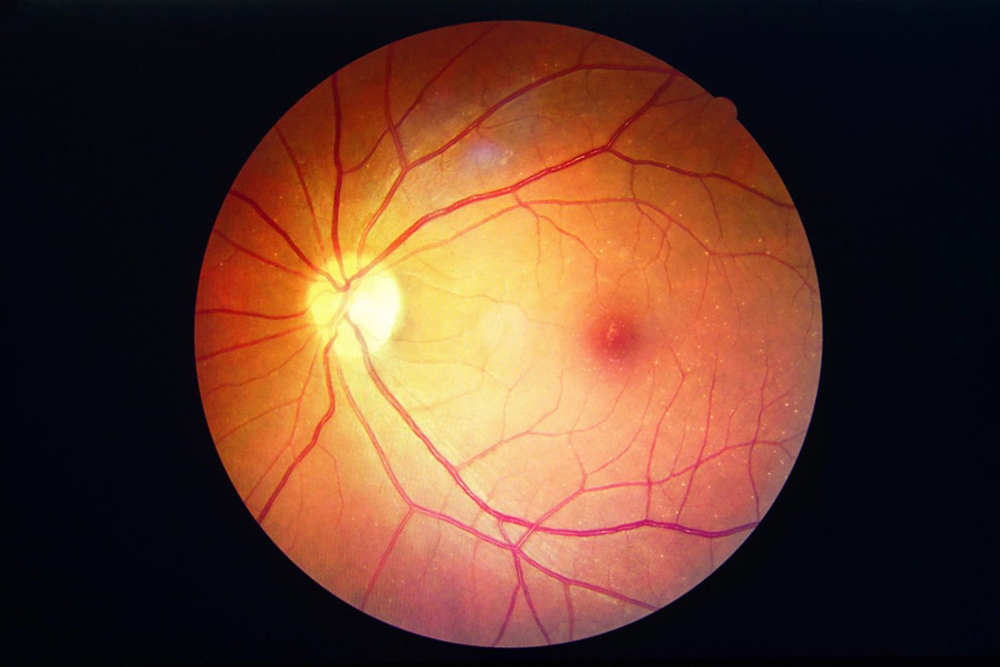 Pandemia teve impacto no diagnóstico de retinopatia diabética