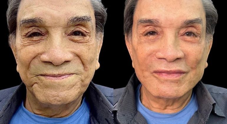 Dedé Santana passa por harmonização facial aos 86 anos; veja como ele ficou